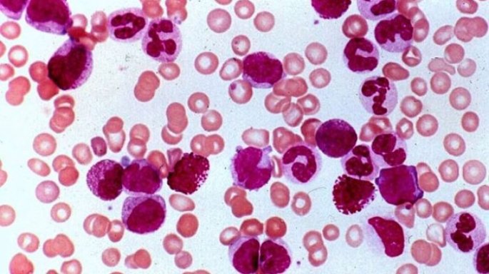 Kanker darah (leukemia)