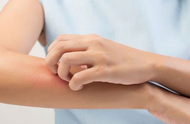 Jenis-jenis Penyakit Kulit Dan Penyebabnya