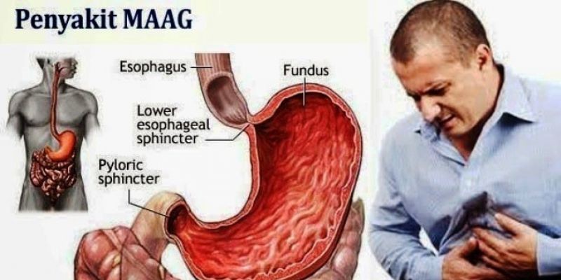 Pengertian Singkat Tentang Sakit Maag